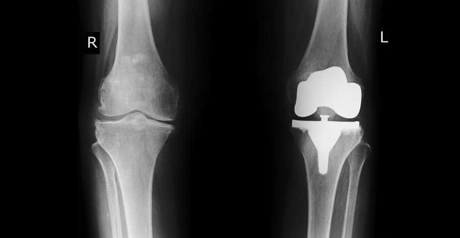 Artificial Knee Replacement