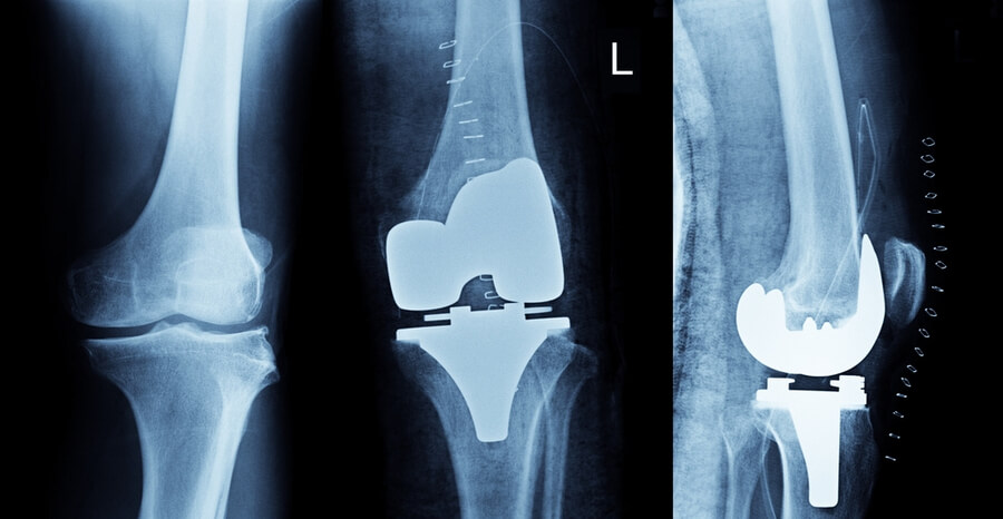 revision knee replacement, Revision Knee Replacement