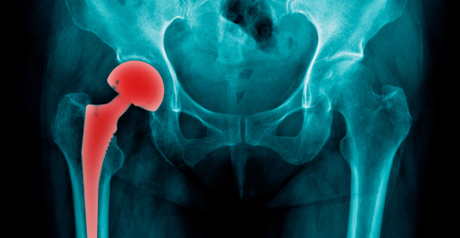 , Revision Hip Replacement